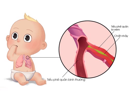 Giải đáp thắc mắc: VIÊM TIỂU PHẾ QUẢN CÓ NGUY HIỂM KHÔNG?